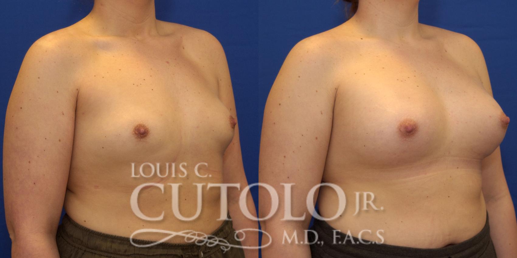 Before & After Breast Augmentation Case 164 View #4 View in Brooklyn, Staten Island, Queens, NY