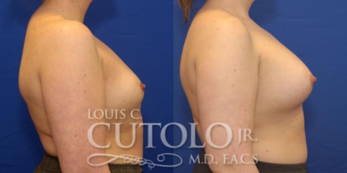 Before & After Breast Augmentation Case 164 View #5 View in Brooklyn, Staten Island, Queens, NY