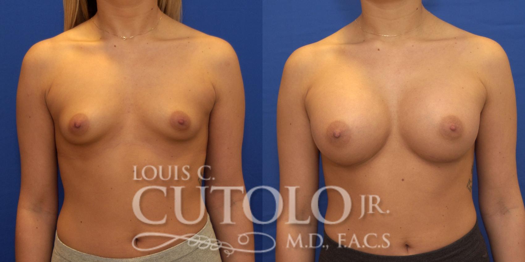 Before & After Breast Augmentation Case 169 View #1 View in Brooklyn, Staten Island, Queens, NY