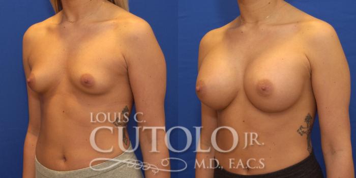 Before & After Breast Augmentation Case 169 View #2 View in Brooklyn, Staten Island, Queens, NY