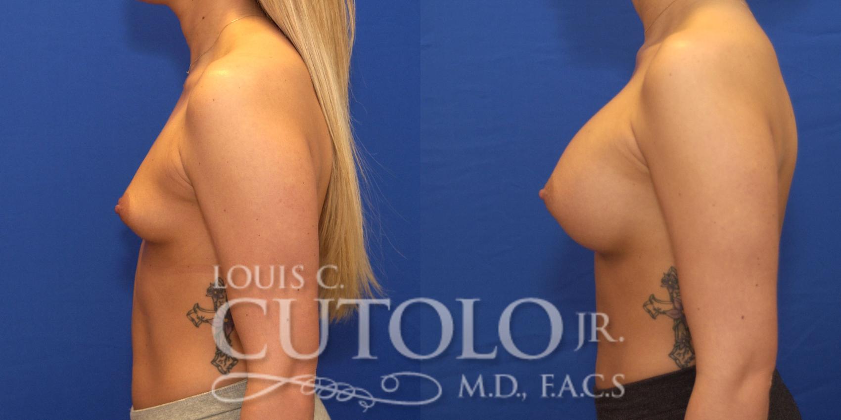 Before & After Breast Augmentation Case 169 View #3 View in Brooklyn, Staten Island, Queens, NY