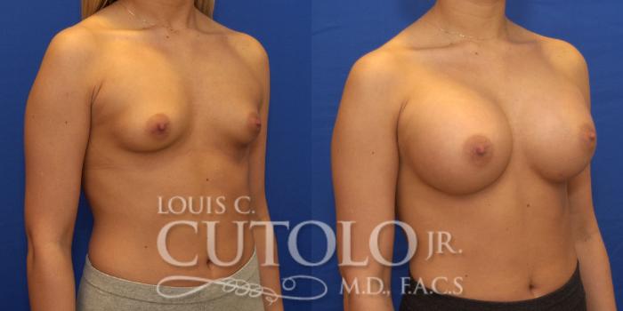 Before & After Breast Augmentation Case 169 View #4 View in Brooklyn, Staten Island, Queens, NY