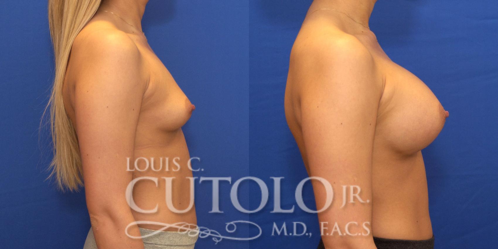 Before & After Breast Augmentation Case 169 View #5 View in Brooklyn, Staten Island, Queens, NY