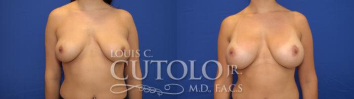 Before & After Breast Augmentation Case 17 View #1 View in Brooklyn, Staten Island, Queens, NY