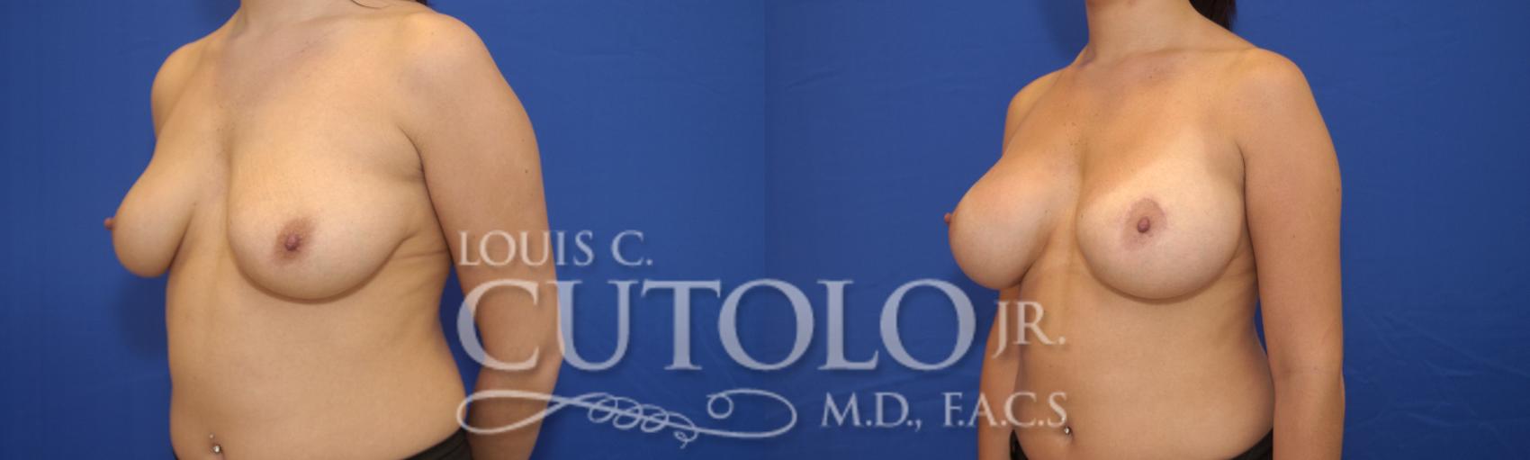Before & After Breast Augmentation Case 17 View #2 View in Brooklyn, Staten Island, Queens, NY