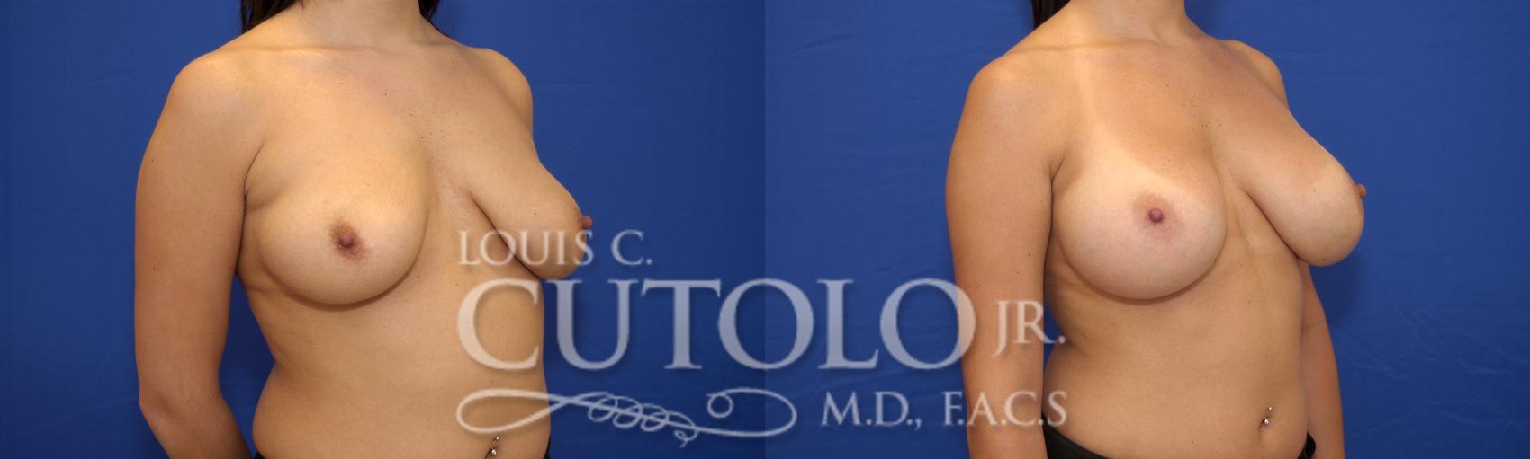 Before & After Breast Augmentation Case 17 View #3 View in Brooklyn, Staten Island, Queens, NY