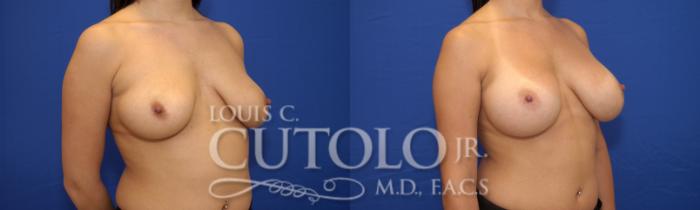 Before & After Breast Augmentation Case 17 View #3 View in Brooklyn, Staten Island, Queens, NY