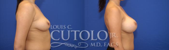 Before & After Breast Augmentation Case 17 View #5 View in Brooklyn, Staten Island, Queens, NY