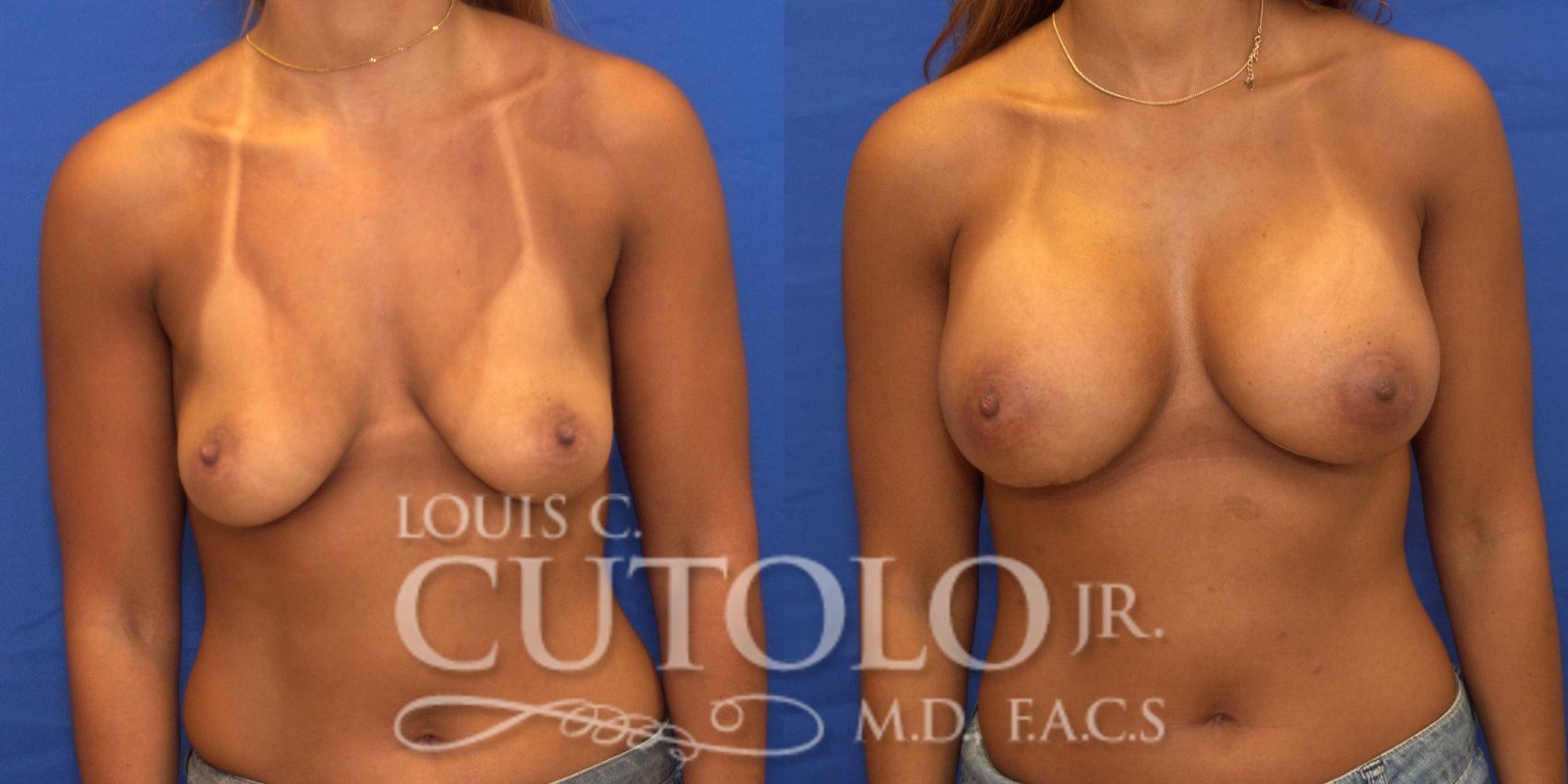 Before & After Breast Augmentation Case 172 View #1 View in Brooklyn, Staten Island, Queens, NY