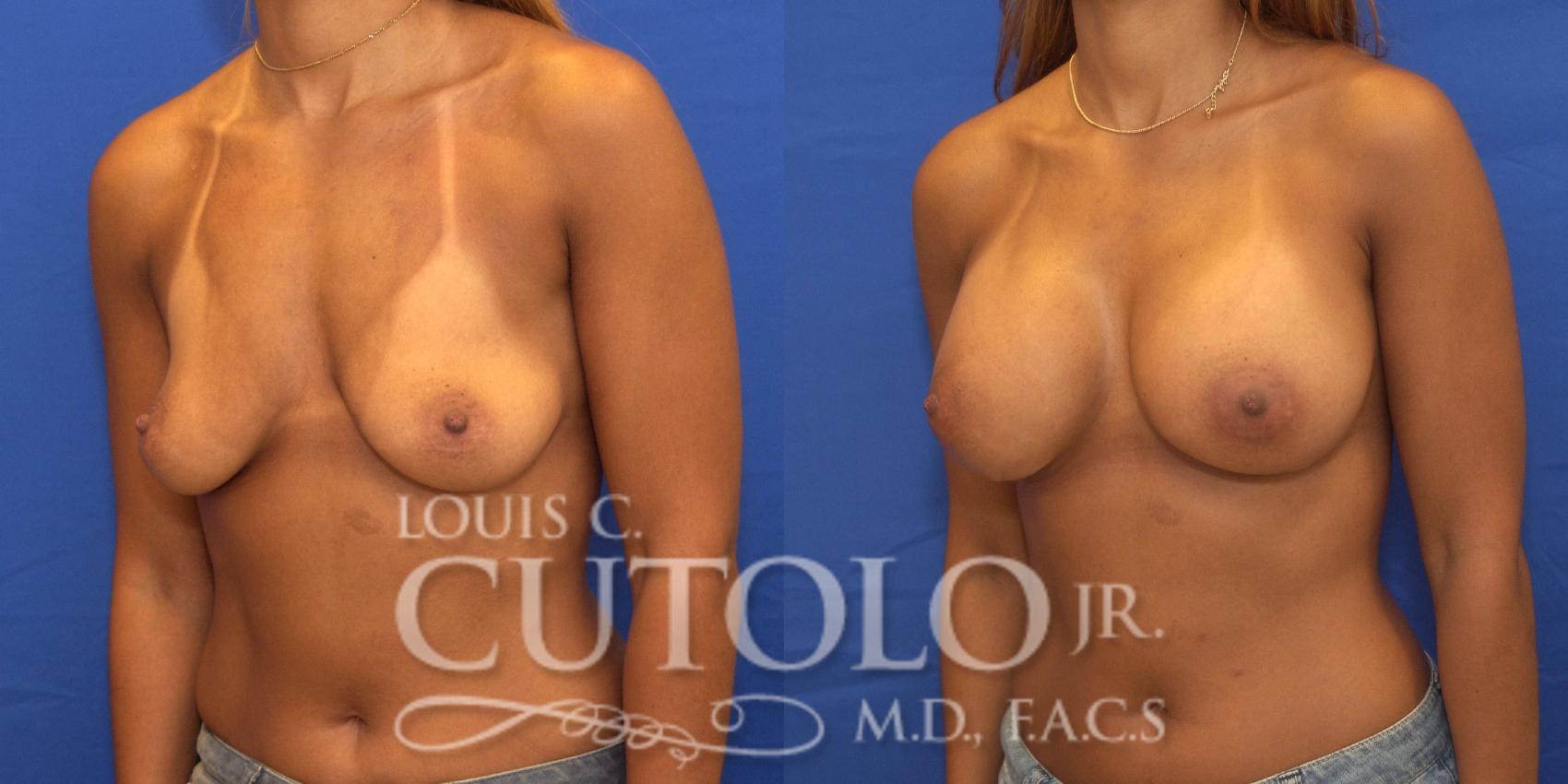Before & After Breast Augmentation Case 172 View #2 View in Brooklyn, Staten Island, Queens, NY