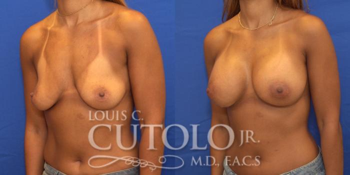 Before & After Breast Augmentation Case 172 View #2 View in Brooklyn, Staten Island, Queens, NY