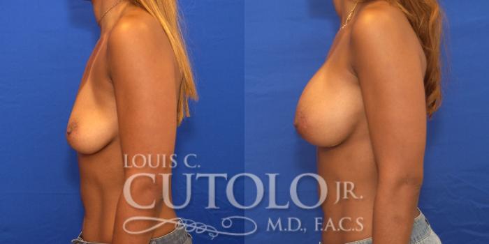 Before & After Breast Augmentation Case 172 View #3 View in Brooklyn, Staten Island, Queens, NY