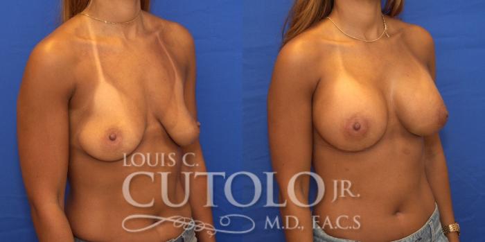 Before & After Breast Augmentation Case 172 View #4 View in Brooklyn, Staten Island, Queens, NY