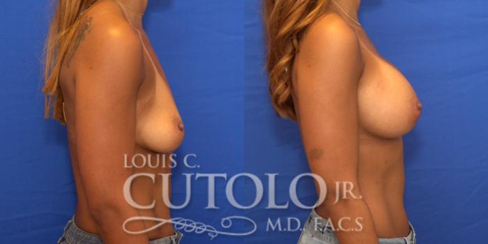Before & After Breast Augmentation Case 172 View #5 View in Brooklyn, Staten Island, Queens, NY
