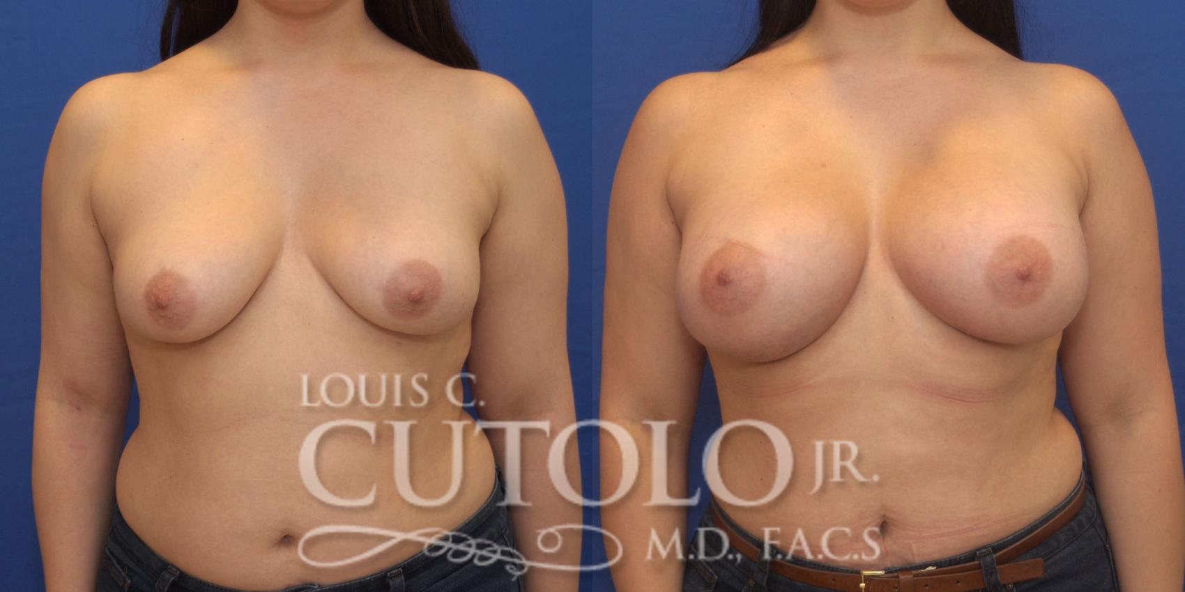 Before & After Breast Augmentation Case 173 View #1 View in Brooklyn, Staten Island, Queens, NY
