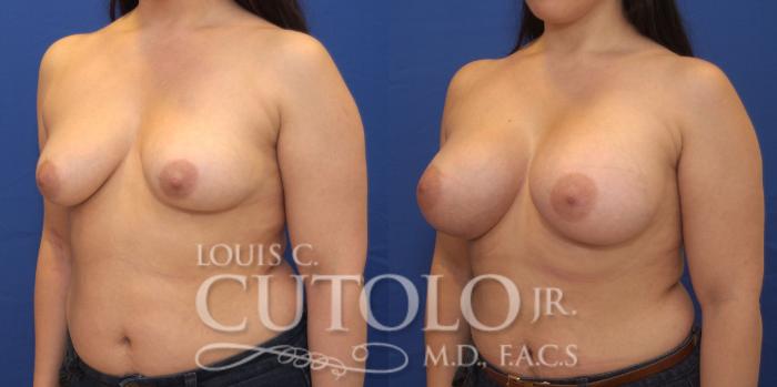 Before & After Breast Augmentation Case 173 View #2 View in Brooklyn, Staten Island, Queens, NY