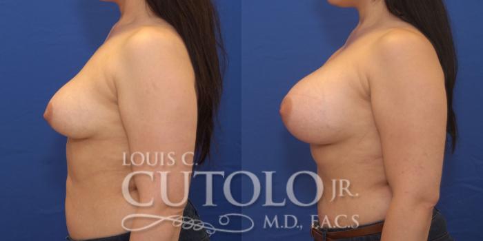 Before & After Breast Augmentation Case 173 View #3 View in Brooklyn, Staten Island, Queens, NY
