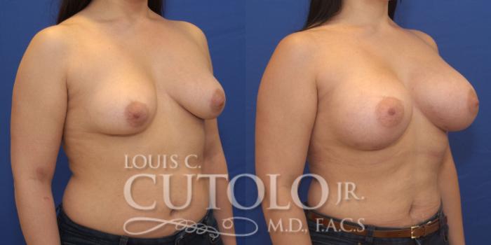 Before & After Breast Augmentation Case 173 View #4 View in Brooklyn, Staten Island, Queens, NY