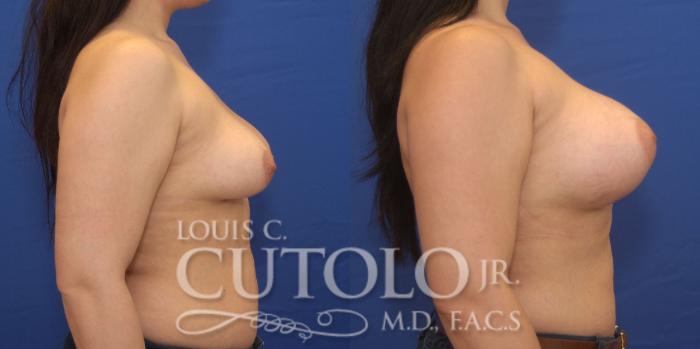 Before & After Breast Augmentation Case 173 View #5 View in Brooklyn, Staten Island, Queens, NY