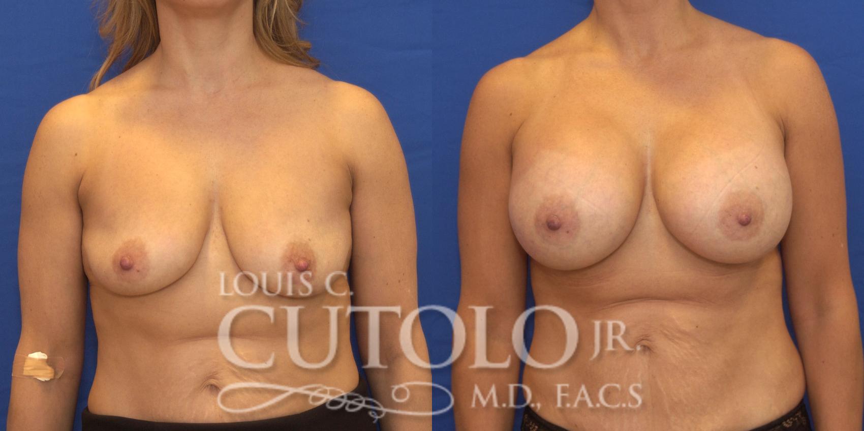 Before & After Breast Augmentation Case 174 View #1 View in Brooklyn, Staten Island, Queens, NY