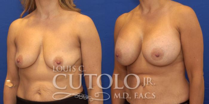 Before & After Breast Augmentation Case 174 View #2 View in Brooklyn, Staten Island, Queens, NY