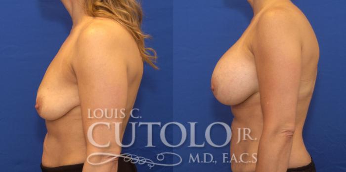Before & After Breast Augmentation Case 174 View #3 View in Brooklyn, Staten Island, Queens, NY