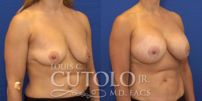 Before & After Breast Augmentation Case 174 View #4 View in Brooklyn, Staten Island, Queens, NY