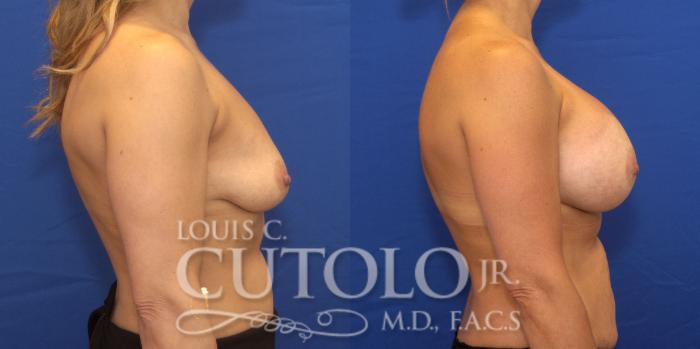 Before & After Breast Augmentation Case 174 View #5 View in Brooklyn, Staten Island, Queens, NY