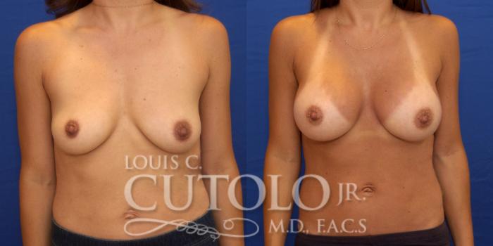 Before & After Breast Augmentation Case 175 View #1 View in Brooklyn, Staten Island, Queens, NY
