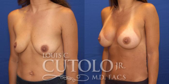 Before & After Breast Augmentation Case 175 View #2 View in Brooklyn, Staten Island, Queens, NY