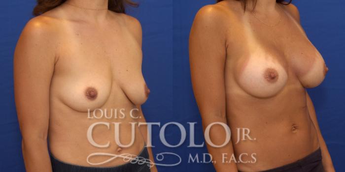Before & After Breast Augmentation Case 175 View #4 View in Brooklyn, Staten Island, Queens, NY