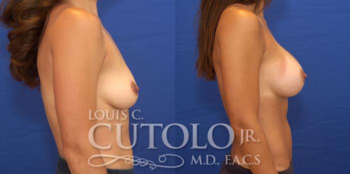 Before & After Breast Augmentation Case 175 View #5 View in Brooklyn, Staten Island, Queens, NY