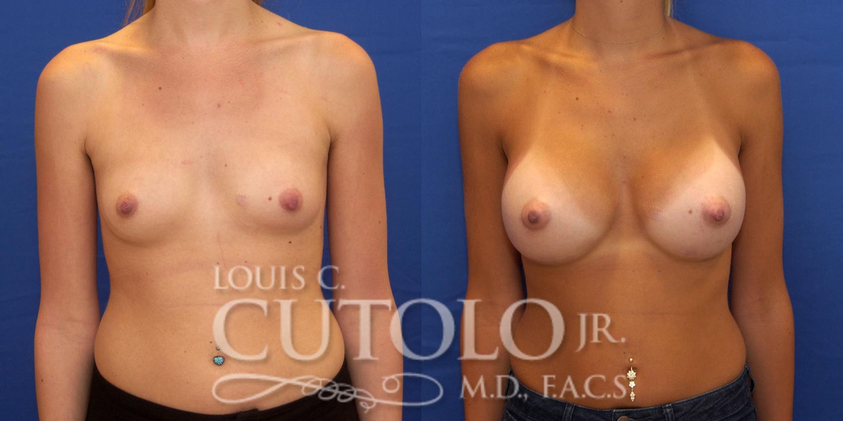 Before & After Breast Augmentation Case 176 View #1 View in Brooklyn, Staten Island, Queens, NY
