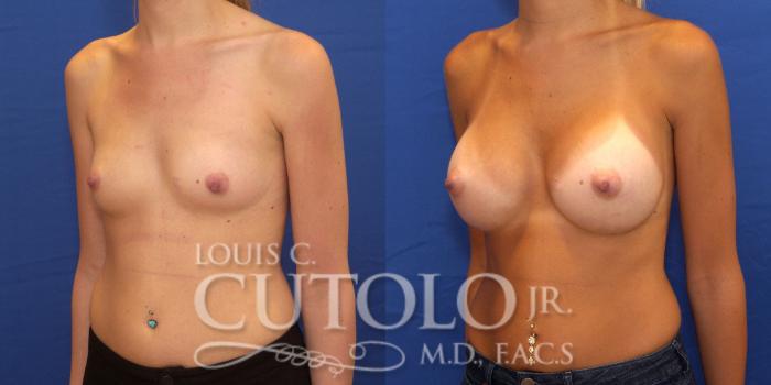 Before & After Breast Augmentation Case 176 View #2 View in Brooklyn, Staten Island, Queens, NY