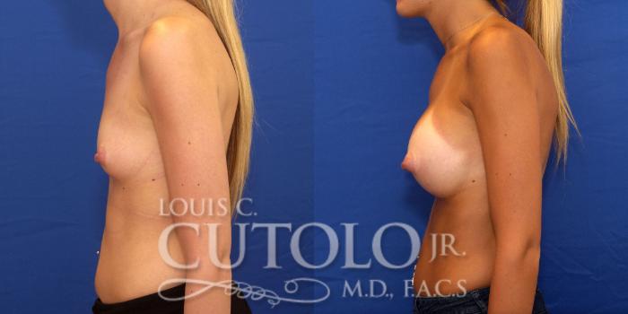 Before & After Breast Augmentation Case 176 View #3 View in Brooklyn, Staten Island, Queens, NY