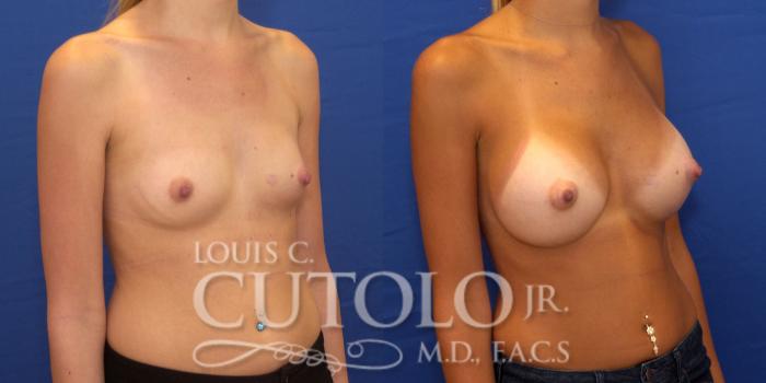 Before & After Breast Augmentation Case 176 View #4 View in Brooklyn, Staten Island, Queens, NY