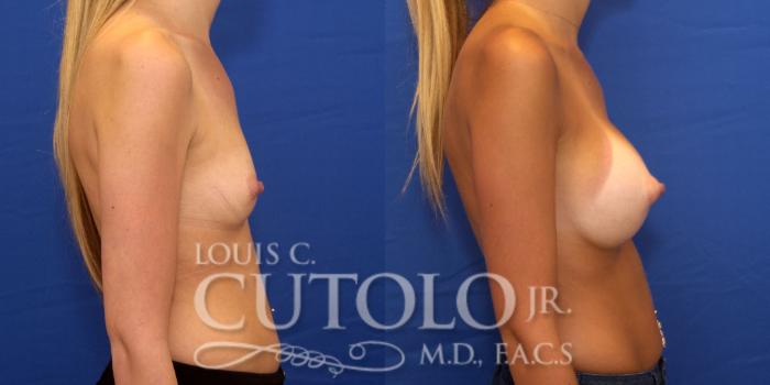 Before & After Breast Augmentation Case 176 View #5 View in Brooklyn, Staten Island, Queens, NY