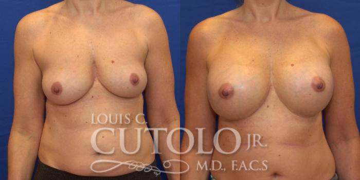 Before & After Breast Augmentation Case 178 View #1 View in Brooklyn, Staten Island, Queens, NY