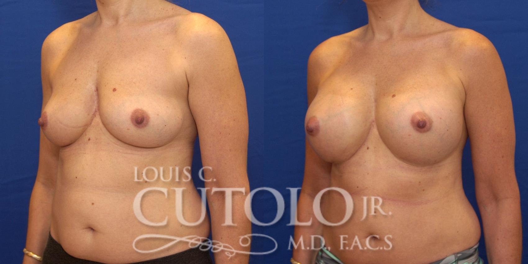 Before & After Breast Augmentation Case 178 View #2 View in Brooklyn, Staten Island, Queens, NY