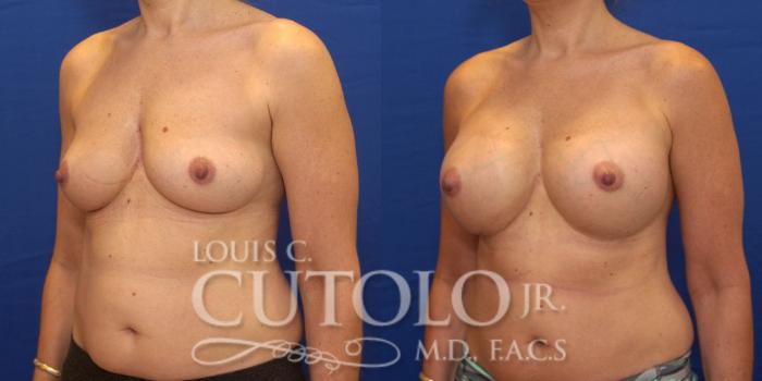 Before & After Breast Augmentation Case 178 View #2 View in Brooklyn, Staten Island, Queens, NY