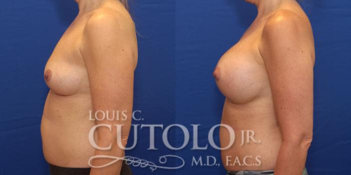 Before & After Breast Augmentation Case 178 View #3 View in Brooklyn, Staten Island, Queens, NY