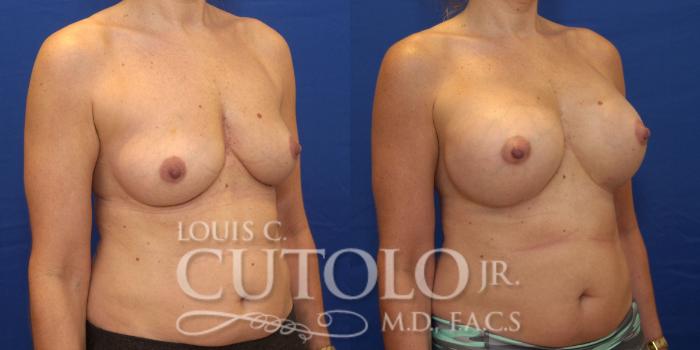 Before & After Breast Augmentation Case 178 View #4 View in Brooklyn, Staten Island, Queens, NY