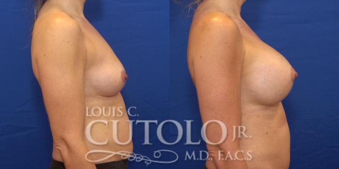 Before & After Breast Augmentation Case 178 View #5 View in Brooklyn, Staten Island, Queens, NY
