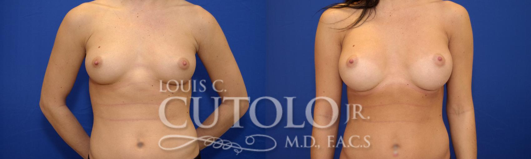 Before & After Breast Augmentation Case 18 View #1 View in Brooklyn, Staten Island, Queens, NY