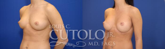 Before & After Breast Augmentation Case 18 View #2 View in Brooklyn, Staten Island, Queens, NY