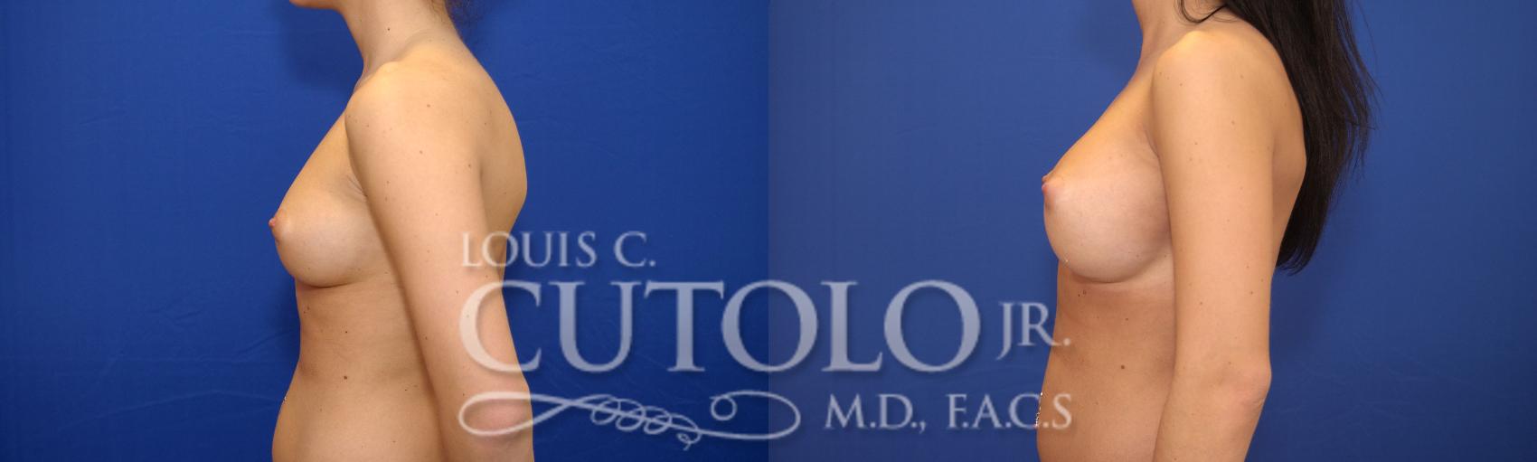 Before & After Breast Augmentation Case 18 View #5 View in Brooklyn, Staten Island, Queens, NY