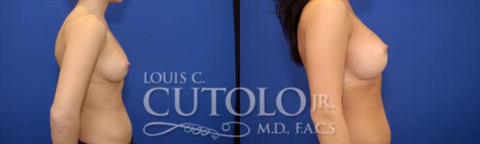 Before & After Breast Augmentation Case 18 View #6 View in Brooklyn, Staten Island, Queens, NY
