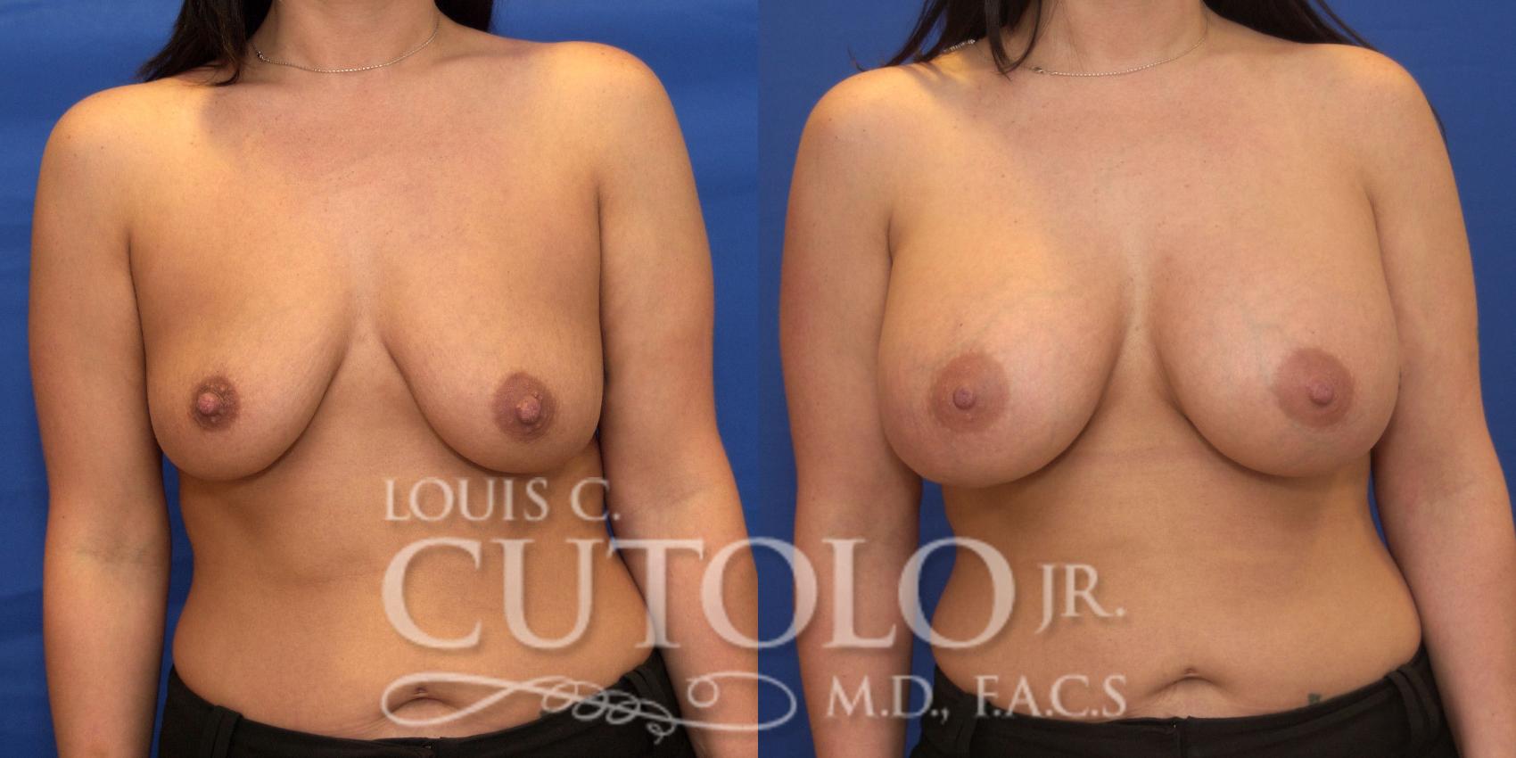 Before & After Breast Augmentation Case 182 View #1 View in Brooklyn, Staten Island, Queens, NY