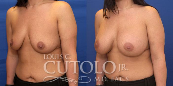 Before & After Breast Augmentation Case 182 View #2 View in Brooklyn, Staten Island, Queens, NY