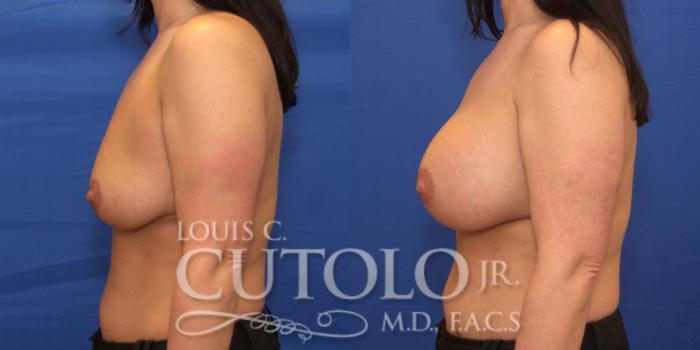 Before & After Breast Augmentation Case 182 View #3 View in Brooklyn, Staten Island, Queens, NY